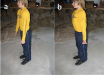 Poor standing posture